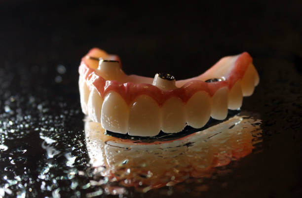 Close-up view of permanent dentures showcasing realistic teeth and a natural appearance.